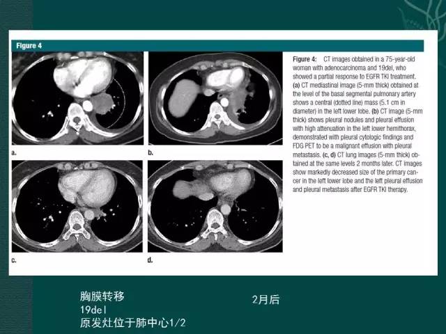 【PPT】非小细胞肺癌 EGFR 基因突变的影像学诊断文献复习