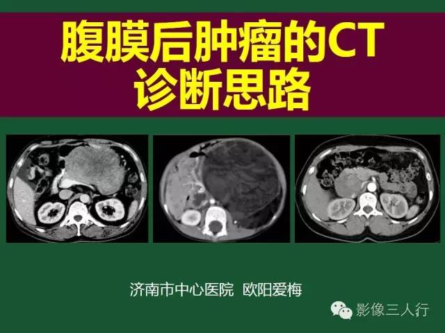 【PPT】腹膜后肿瘤的CT诊断思路