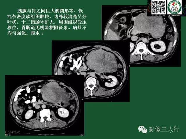 【PPT】腹膜后肿瘤的CT诊断思路