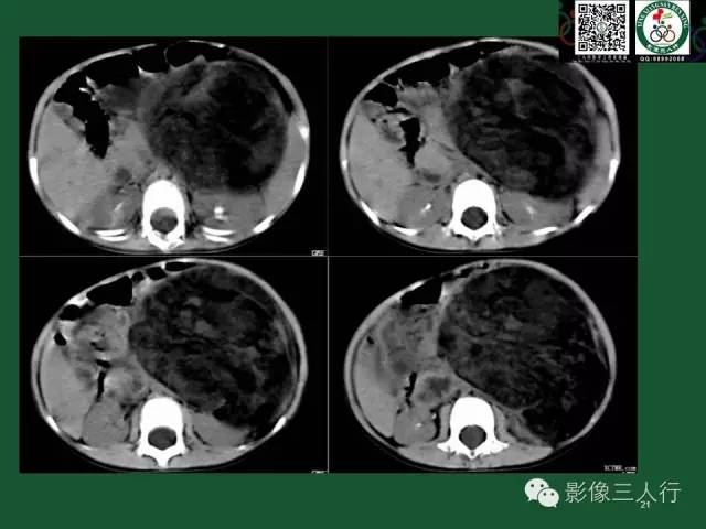 【PPT】腹膜后肿瘤的CT诊断思路