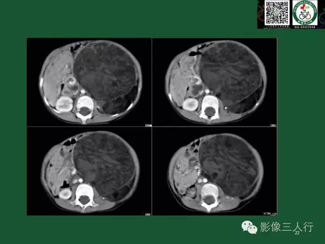 【PPT】腹膜后肿瘤的CT诊断思路
