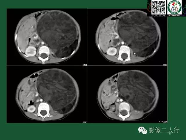 【PPT】腹膜后肿瘤的CT诊断思路