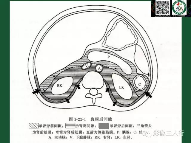 【PPT】腹膜后肿瘤的CT诊断思路