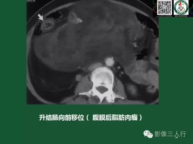 【PPT】腹膜后肿瘤的CT诊断思路