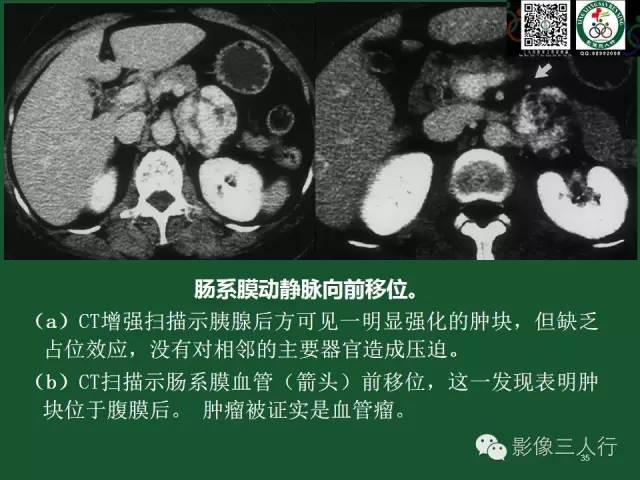 【PPT】腹膜后肿瘤的CT诊断思路