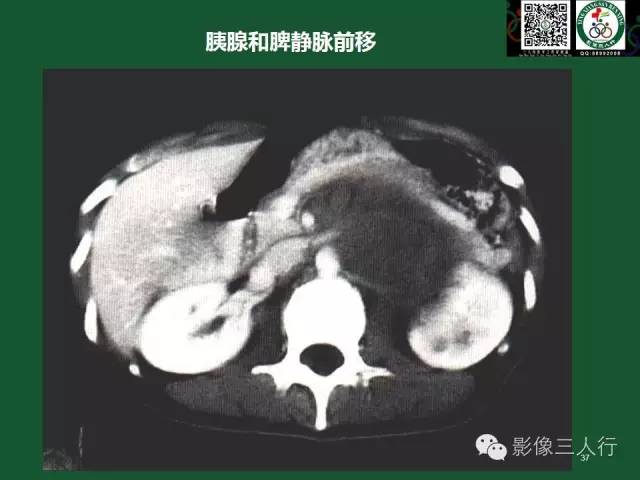 【PPT】腹膜后肿瘤的CT诊断思路
