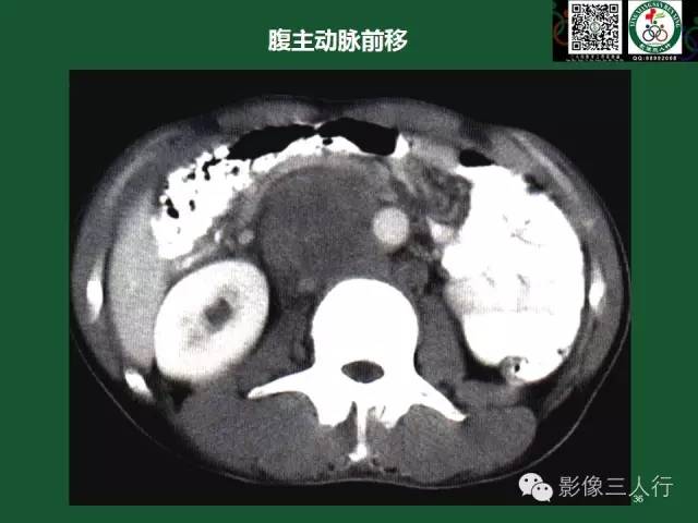 【PPT】腹膜后肿瘤的CT诊断思路