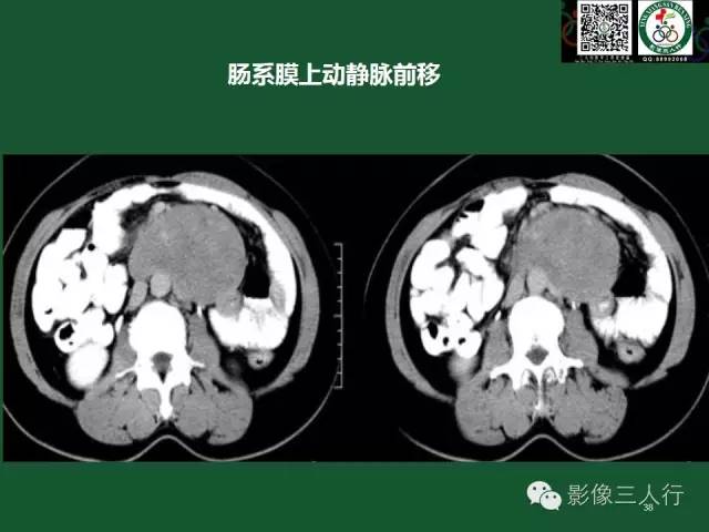 【PPT】腹膜后肿瘤的CT诊断思路