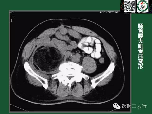 【PPT】腹膜后肿瘤的CT诊断思路