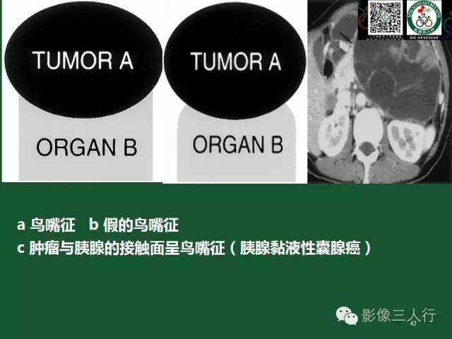 【PPT】腹膜后肿瘤的CT诊断思路
