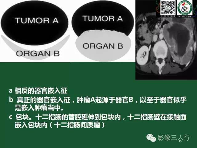 【PPT】腹膜后肿瘤的CT诊断思路