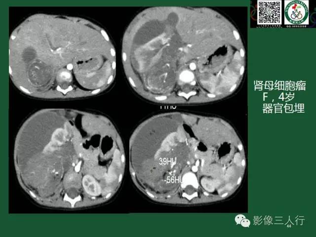 【PPT】腹膜后肿瘤的CT诊断思路