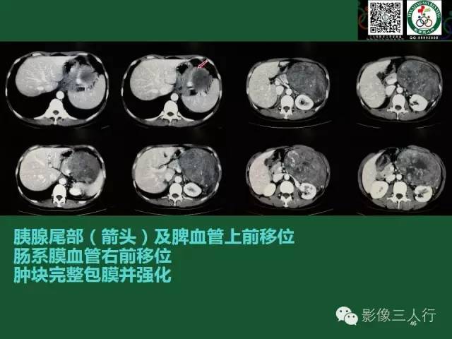 【PPT】腹膜后肿瘤的CT诊断思路