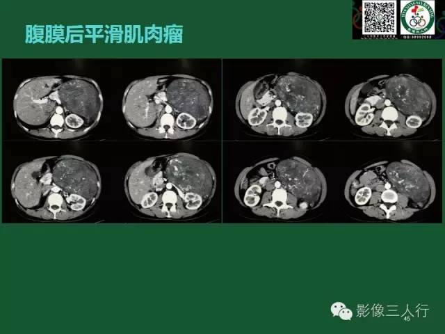 【PPT】腹膜后肿瘤的CT诊断思路