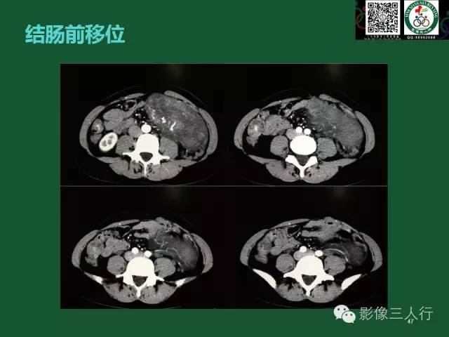 【PPT】腹膜后肿瘤的CT诊断思路