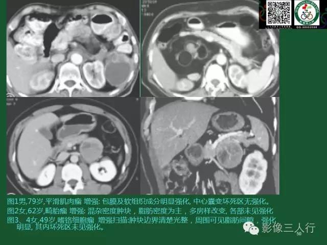 【PPT】腹膜后肿瘤的CT诊断思路