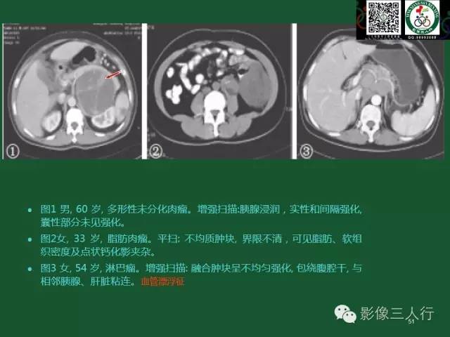 【PPT】腹膜后肿瘤的CT诊断思路