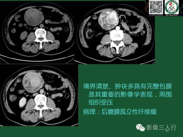 【PPT】腹膜后肿瘤的CT诊断思路