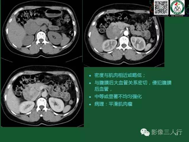 【PPT】腹膜后肿瘤的CT诊断思路