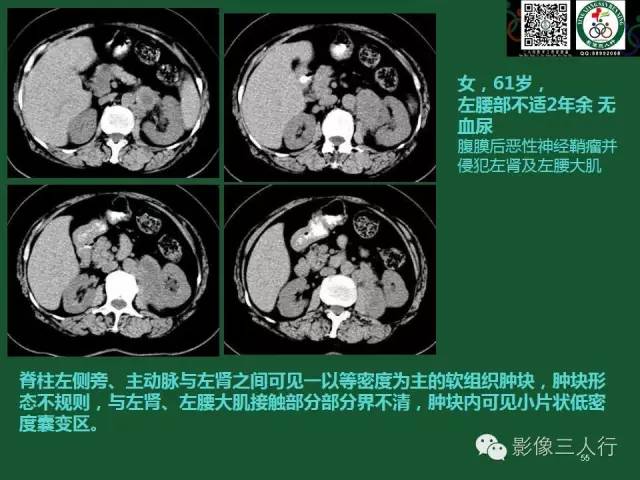 【PPT】腹膜后肿瘤的CT诊断思路