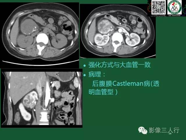 【PPT】腹膜后肿瘤的CT诊断思路