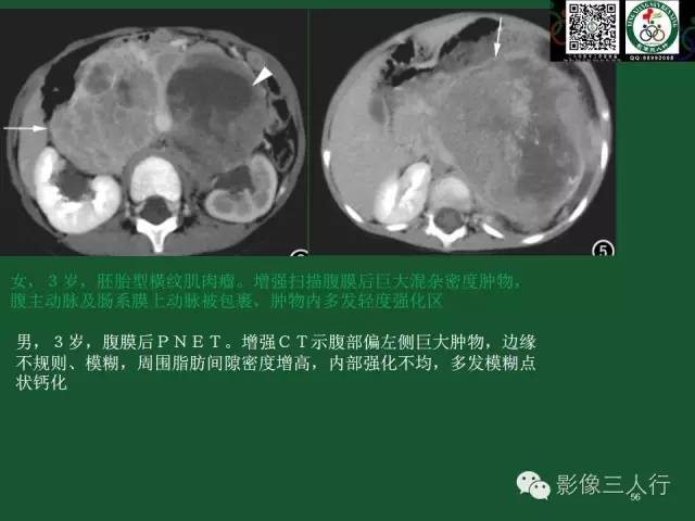 【PPT】腹膜后肿瘤的CT诊断思路