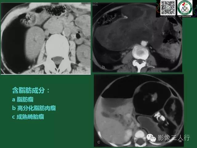 【PPT】腹膜后肿瘤的CT诊断思路