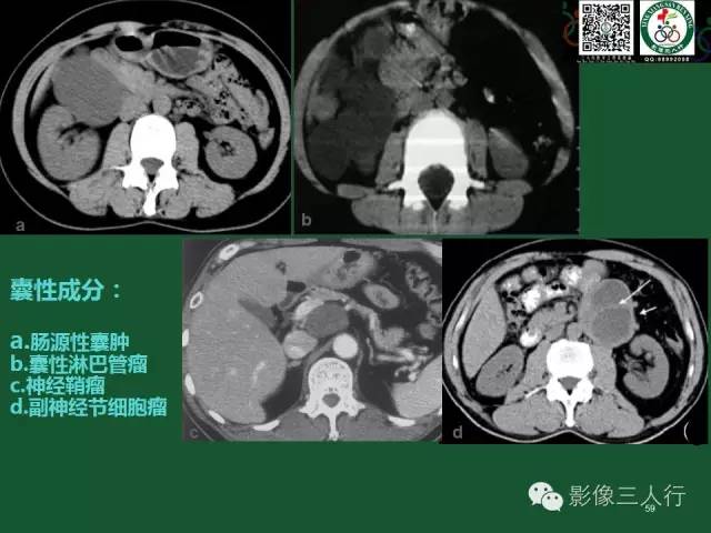 【PPT】腹膜后肿瘤的CT诊断思路