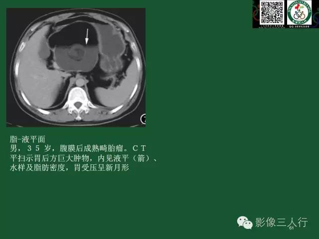 【PPT】腹膜后肿瘤的CT诊断思路