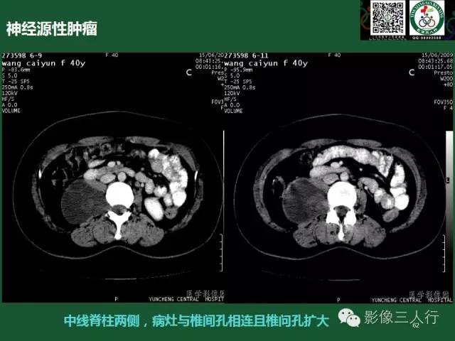 【PPT】腹膜后肿瘤的CT诊断思路