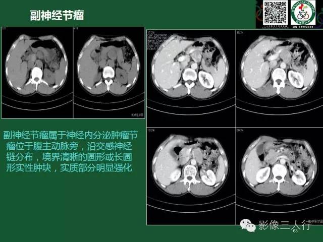【PPT】腹膜后肿瘤的CT诊断思路