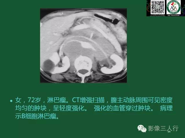 【PPT】腹膜后肿瘤的CT诊断思路