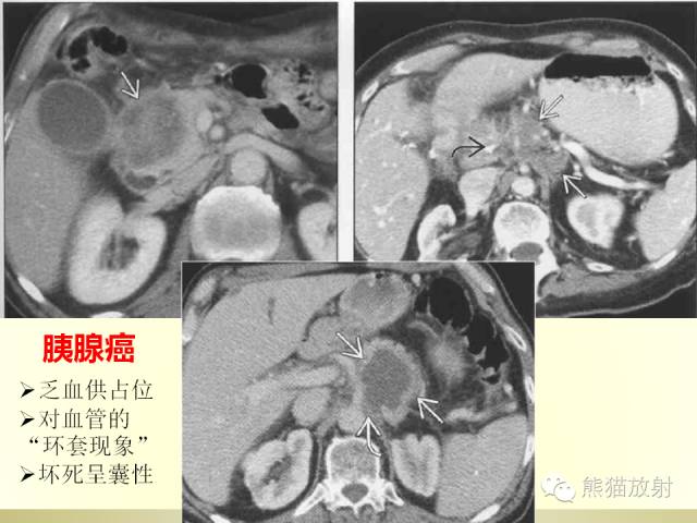 【PPT】胰腺CT增强扫描、血管评价及病变诊断