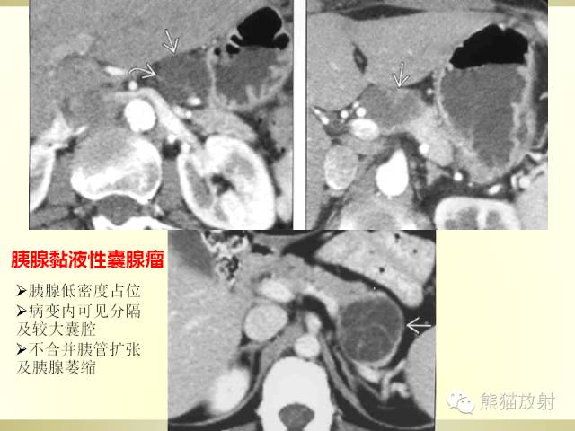 【PPT】胰腺CT增强扫描、血管评价及病变诊断