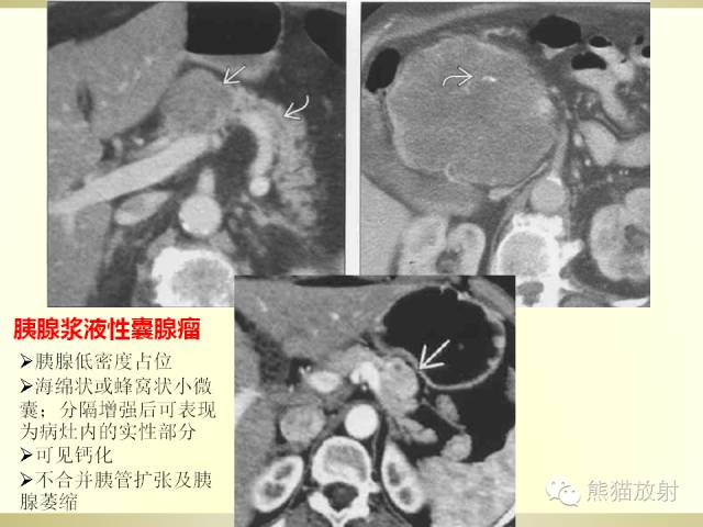【PPT】胰腺CT增强扫描、血管评价及病变诊断