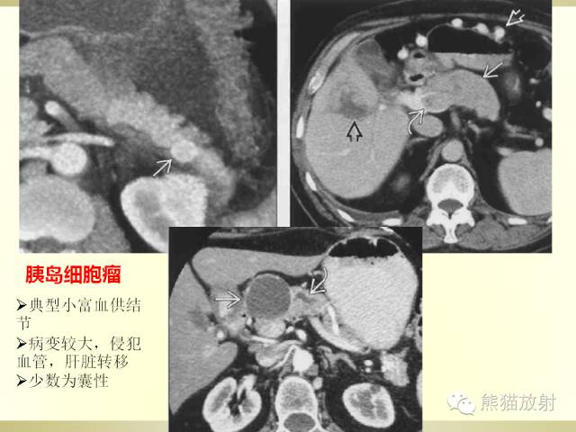 【PPT】胰腺CT增强扫描、血管评价及病变诊断