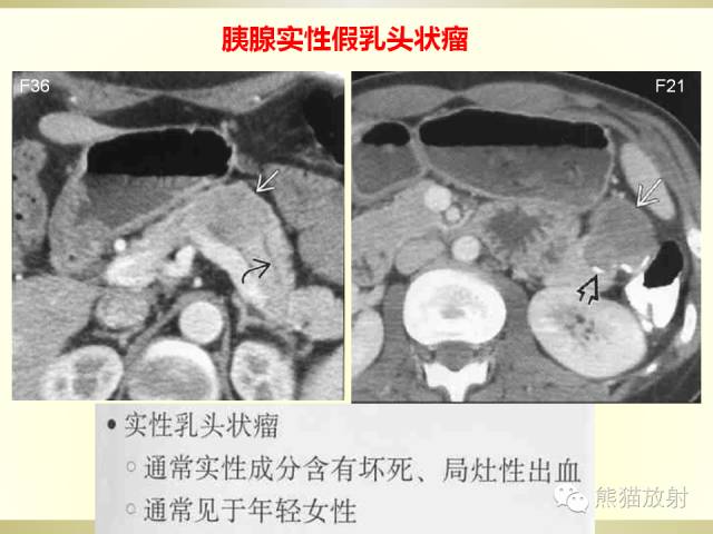 【PPT】胰腺CT增强扫描、血管评价及病变诊断
