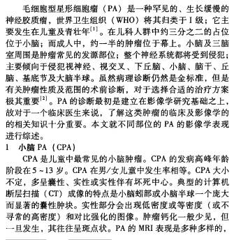 毛细胞型星形细胞瘤的影像学诊断（综述）