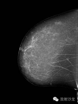 【病例】乳腺多发性血管脂肪瘤一例影像表现