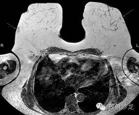 【病例】乳腺多发性血管脂肪瘤一例影像表现 【病例】乳腺多发性血管脂肪瘤一例影像表现