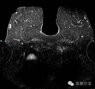 【病例】乳腺多发性血管脂肪瘤一例影像表现 【病例】乳腺多发性血管脂肪瘤一例影像表现