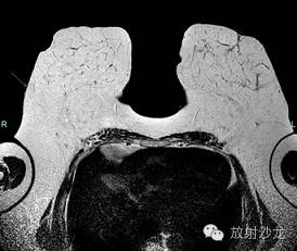 【病例】乳腺多发性血管脂肪瘤一例影像表现 【病例】乳腺多发性血管脂肪瘤一例影像表现