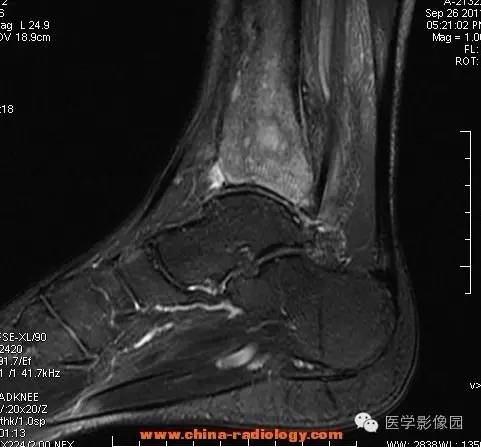 【病例】胫骨骨脓肿1例MR影像表现 【病例】胫骨骨脓肿1例MR影像表现