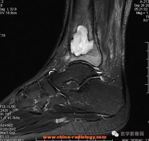 【病例】胫骨骨脓肿1例MR影像表现 【病例】胫骨骨脓肿1例MR影像表现