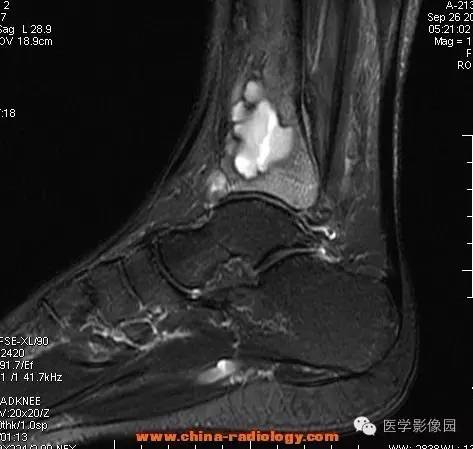 【病例】胫骨骨脓肿1例MR影像表现 【病例】胫骨骨脓肿1例MR影像表现