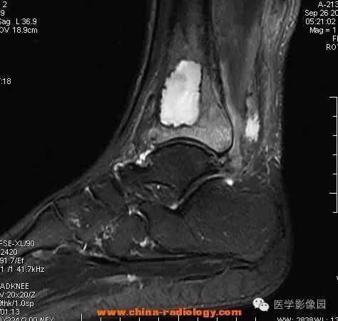 【病例】胫骨骨脓肿1例MR影像表现 【病例】胫骨骨脓肿1例MR影像表现