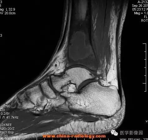 【病例】胫骨骨脓肿1例MR影像表现 【病例】胫骨骨脓肿1例MR影像表现