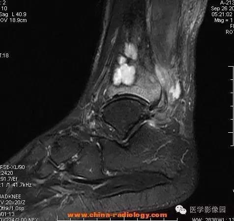 【病例】胫骨骨脓肿1例MR影像表现 【病例】胫骨骨脓肿1例MR影像表现