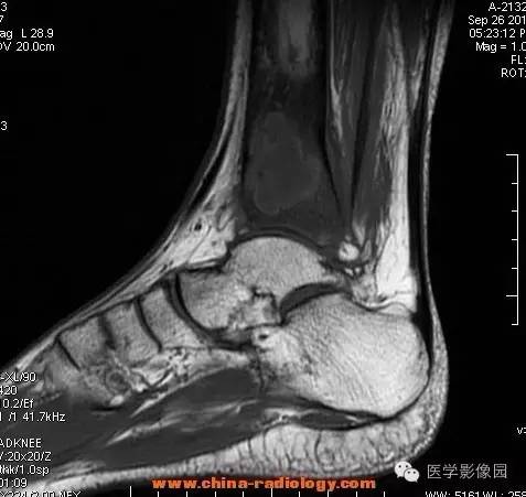 【病例】胫骨骨脓肿1例MR影像表现 【病例】胫骨骨脓肿1例MR影像表现