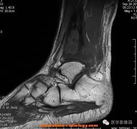 【病例】胫骨骨脓肿1例MR影像表现 【病例】胫骨骨脓肿1例MR影像表现
